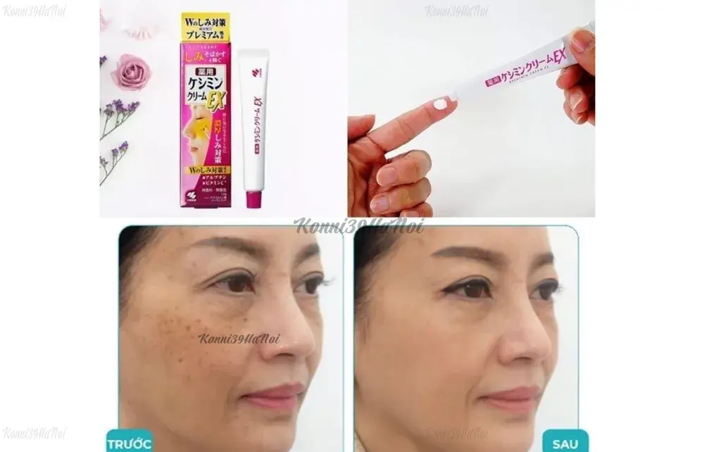 Giảm sạm, nám, tàn nhang hiệu quả với kem trị nám của Nhật Kobayashi EX Nhật Bản