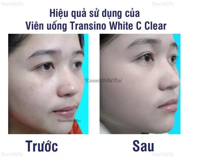 Nên uống transino trắng hay xanh để tình trạng thâm mụn, nám được cải thiện đáng kể sau 2 tháng sử dụng.