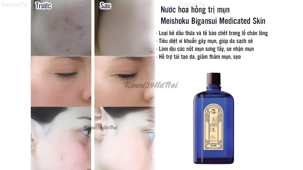 Lotion Meishoku sở hữu bảng thành phần chuyên trị mụn, giảm dầu thừa và kháng viêm hiệu quả