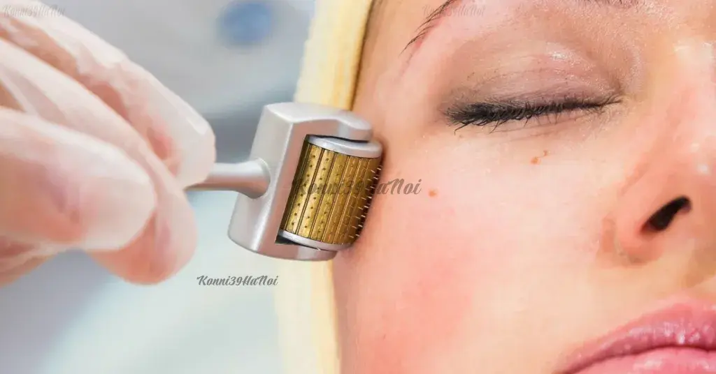 Kích thích sản sinh collagen bằng phương pháp lăn kim