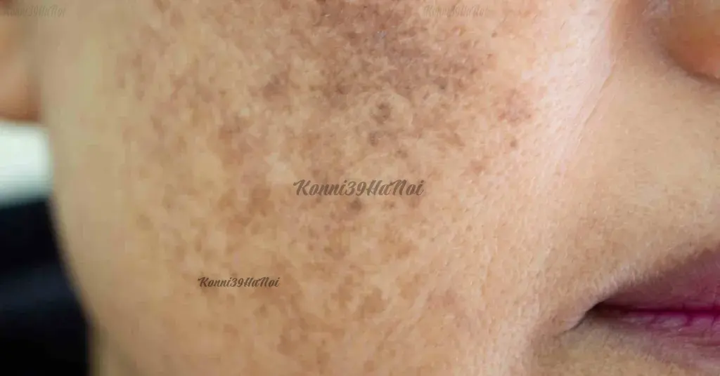 Tình trạng nám ngoại sinh