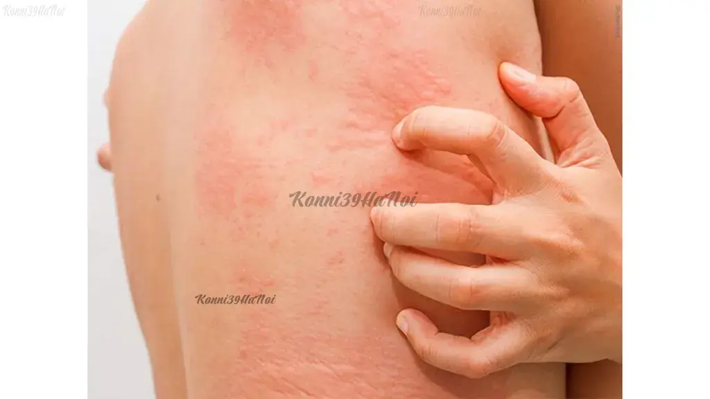 Người có cơ địa dị ứng dễ bị nổi mề đay gây ngứa với những người có cơ địa dị ứng
