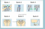 Viên đặt trĩ chữ A Boraginol hộp 10 viên - Ảnh 2